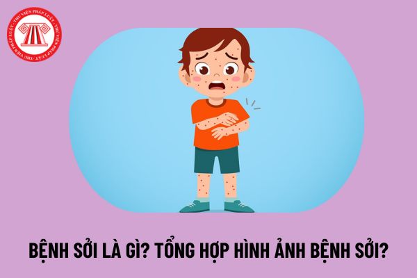 Bệnh sởi là gì? Hình ảnh bệnh sởi? Hình ảnh bệnh sởi ở trẻ em? Hình ảnh bệnh sởi ở người lớn như thế nào?