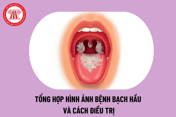 Hình ảnh bệnh bạch hầu? Bệnh bạch hầu lây qua đâu? Tại sao bị bệnh bạch hầu? Cách điều trị bệnh bạch hầu thế nào?