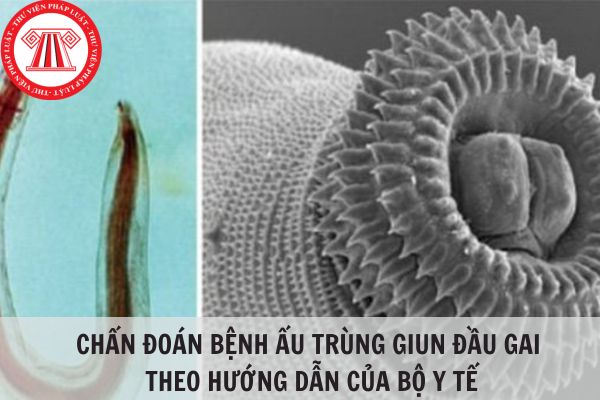 Chẩn đoán bệnh ấu trùng giun đầu gai theo hướng dẫn của Bộ Y tế?