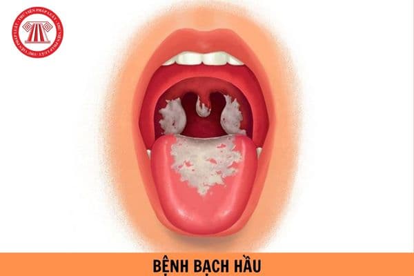 Bệnh bạch hầu được phân loại như thế nào? Tác nhân nào từ đâu gây nên bệnh bạch hầu?