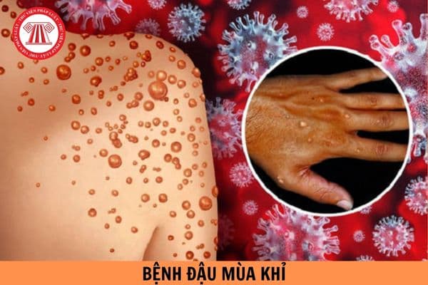 Hướng dẫn nhận biết triệu chứng nghi ngờ bệnh đậu mùa khỉ mới nhất?