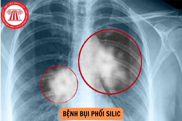 Người lao động làm các nghề, công việc nào có thể bị bệnh bụi phổi silic? 
