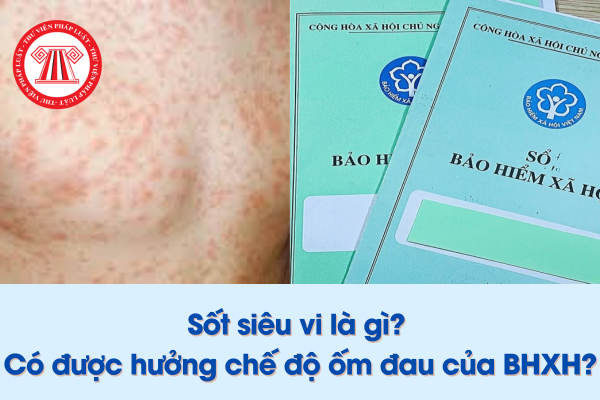 Sốt siêu vi là gì; Sốt siêu vi có được hưởng chế độ ốm đau của BHXH