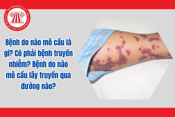 Bệnh do não mô cầu là gì? Có phải bệnh truyền nhiễm? Bệnh do não mô cầu lây truyền qua đường nào?