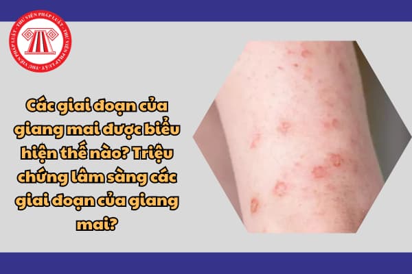 Các giai đoạn của giang mai được biểu hiện thế nào? Triệu chứng lâm sàng các giai đoạn của giang mai?