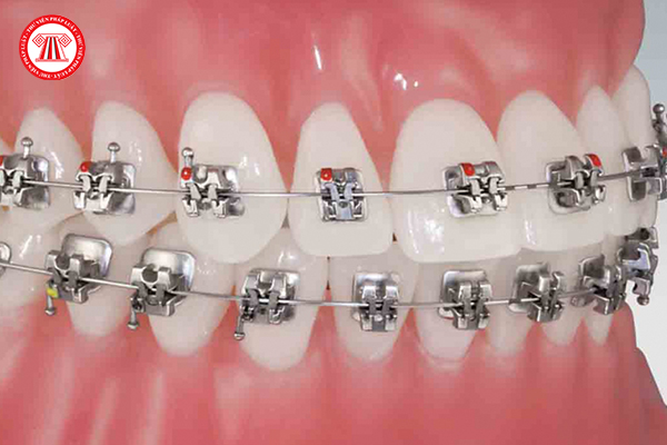 nắn chỉnh răng hai hàm
