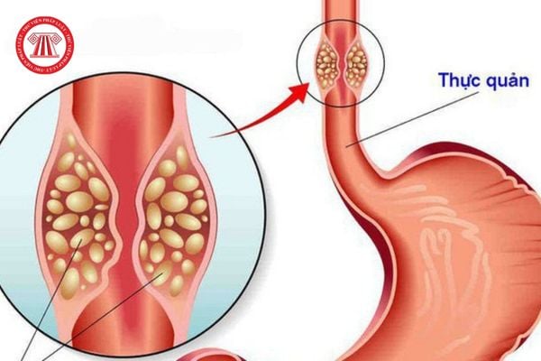 Khâu vết thương thực quản