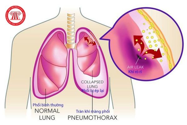Kỹ thuật rửa phổi