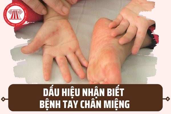 Bệnh Chân Tay Miệng Ủ Bệnh Bao Lâu: Thời Gian, Triệu Chứng và Phòng Ngừa