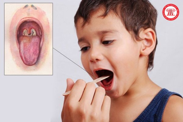 Đau họng 3 ngày liên tiếp có phải là dấu hiệu bị bệnh bạch hầu không? Trẻ em và người lớn phải tiêm bao nhiêu mũi vắc xin để phòng bệnh bạch hầu?