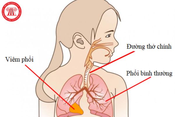 Viêm phổi là gì? Viêm phổi ở trẻ em có tỷ lệ tử vong cao không? Dấu hiệu viêm phổi trẻ em là gì?