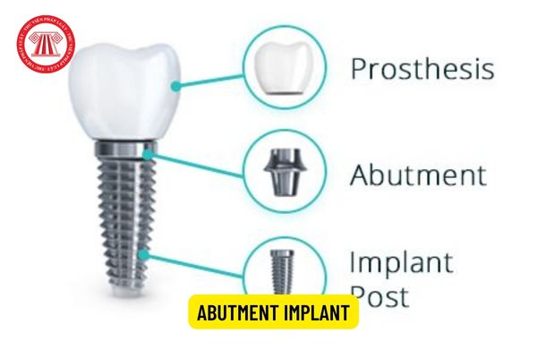 Abutment Implant