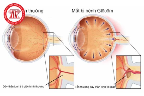 điều trị