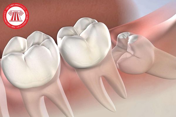 Răng khôn mọc lệch đã có biến chứng được điều trị như thế nào khi điều trị răng khôn mọc lệch có thể xảy ra những biến chứng gì