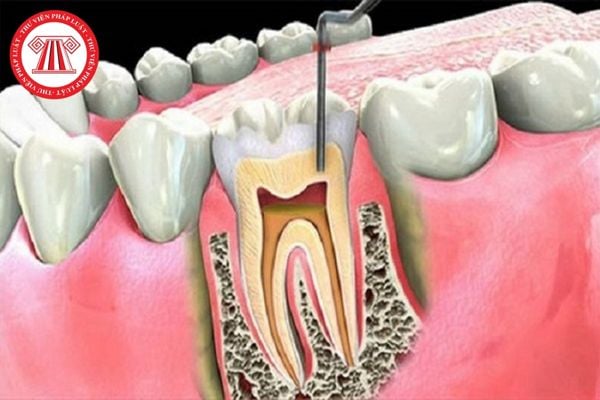 Làm thế nào để chăm sóc và duy trì việc hồi phục sau khi điều trị viêm tủy răng?
