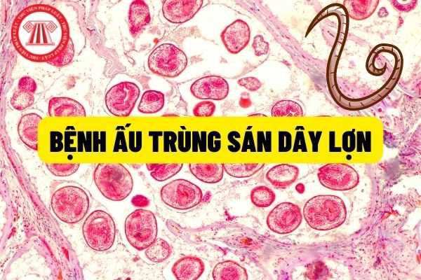 Bệnh ấu trùng sán lợn: Hướng dẫn chuẩn đoán, điều trị phòng bệnh ấu trùng sán dây lợn hiện nay như thế nào?