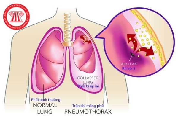 Việc chẩn đoán và điều trị tràn dịch, tràn khí màng phổi ở trẻ em ...