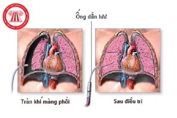 Tràn khí màng phổi