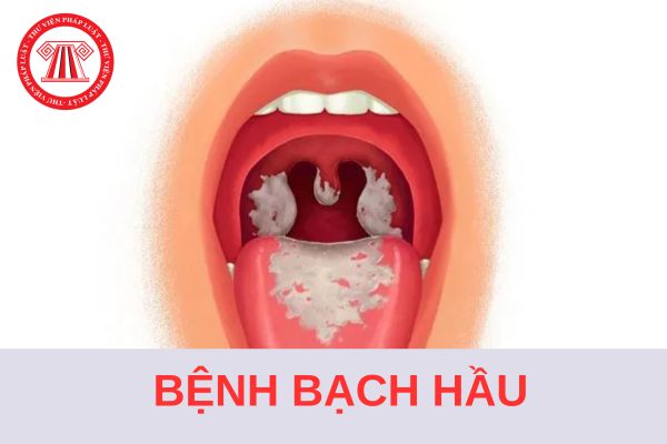 Thời gian ủ bệnh bạch hầu là mấy ngày? Biến chứng bệnh bạch hầu ác tính là biến chứng nào? 