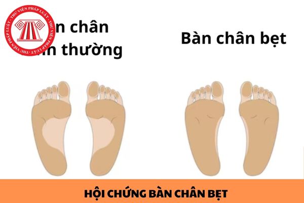 Hội chứng bàn chân bẹt là gì? Bị hội chứng bàn chân bẹt có thi ngành Công an được không?