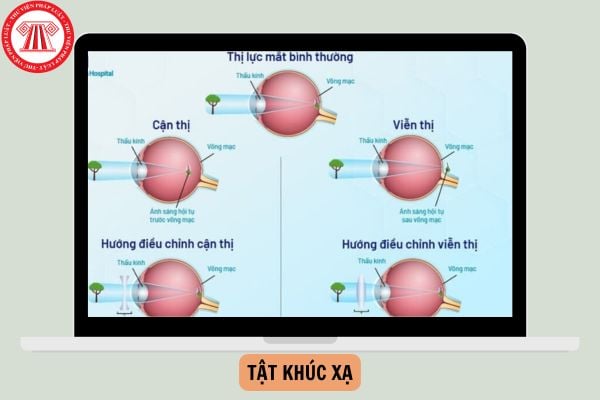 Tật khúc xạ phổ biến nhất hiện nay là gì? Tật khúc xạ ở trẻ em thường là do đâu?