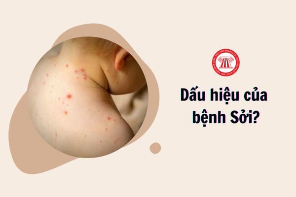 Dấu hiệu của Sởi?