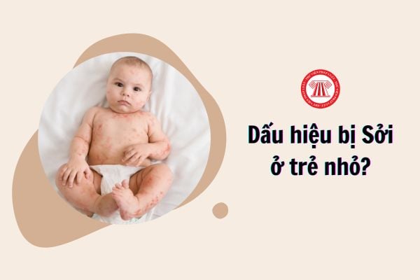 Dấu hiệu bị Sởi ở trẻ?