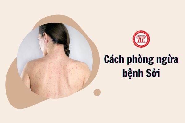 Cách phòng ngừa bệnh Sởi