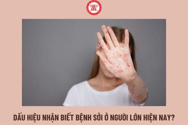 Dấu hiệu nhận biết bệnh Sởi ở người lớn hiện nay? Người lao động bị bệnh Sởi có được hưởng chế độ ốm đau không?