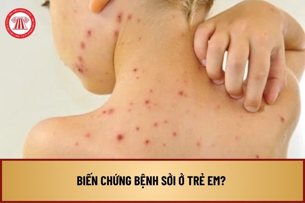 Biến chứng bệnh sởi ở trẻ em? Cách phòng bệnh sởi cho trẻ em theo hướng dẫn của Bộ Y tế như thế nào?