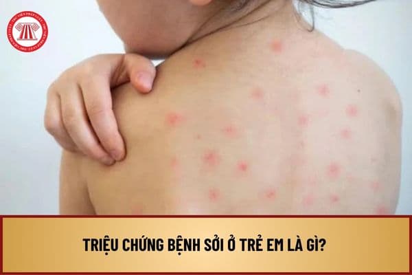 Triệu chứng bệnh sởi ở trẻ em là gì? Trẻ em có thể tử vong do biến chứng của bệnh sởi phải không?