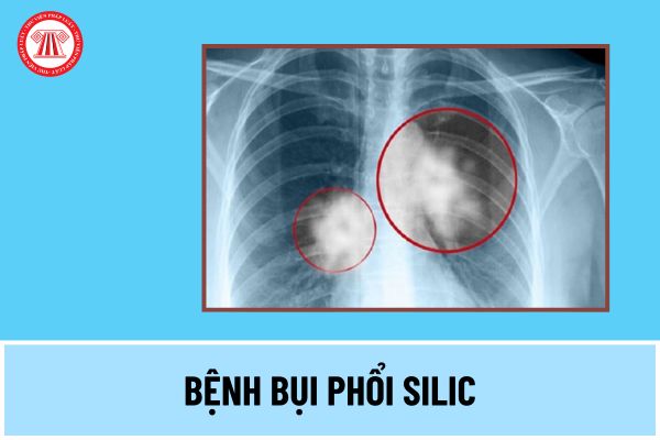 Người lao động làm các nghề, công việc nào có thể bị bệnh bụi phổi silic? Bệnh bụi phổi silic là gì?