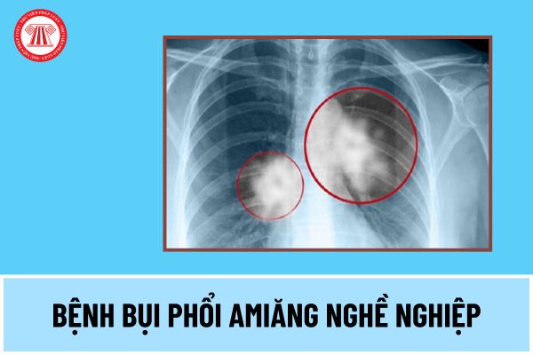 Người lao động làm các nghề, công việc nào có thể bị bệnh bụi phổi amiăng nghề nghiệp theo quy định 2024?