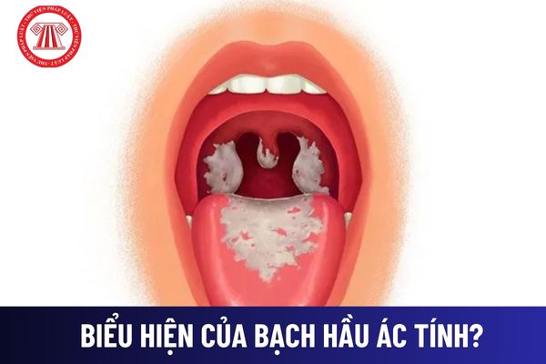 Biểu hiện của bệnh bạch hầu ác tính? Được chích ngừa bạch hầu từ khi nào? Người dân phải làm gì khi có dấu hiệu mắc bệnh bạch hầu?