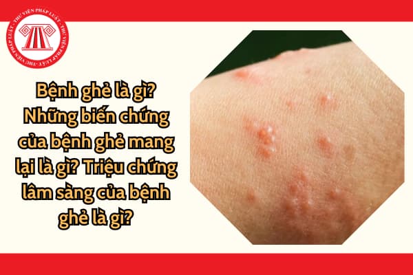 Bệnh ghẻ là gì? Những biến chứng của bệnh ghẻ mang lại là gì? Triệu chứng lâm sàng của bệnh ghẻ là gì?